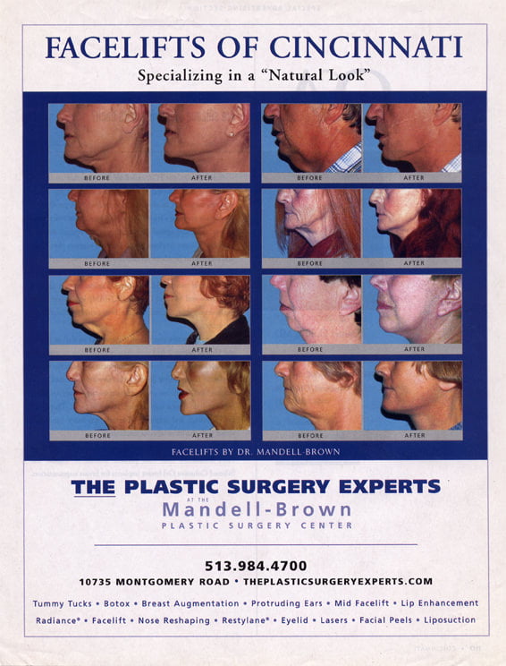 Facelifts of Cincinnati advertisement featuring before and after patients