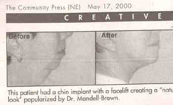 Snapshot from Creative Living Magazine featuring a before and after Facelift patient