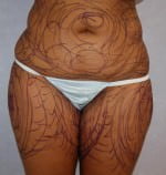Liposuction