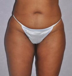 Liposuction