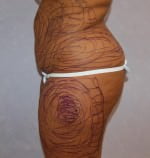 Liposuction