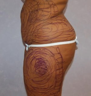Liposuction