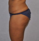 Liposuction