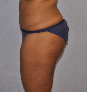 Liposuction