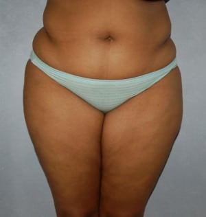 Liposuction