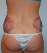 Liposuction