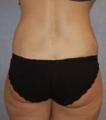 Liposuction