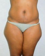 Liposuction