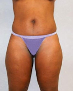 Liposuction