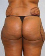Liposuction