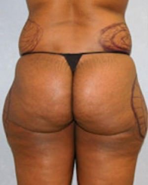 Liposuction