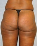 Liposuction