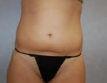 Liposuction