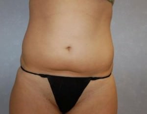 Liposuction Case 2077 Before Photo Liposuction