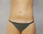 Liposuction