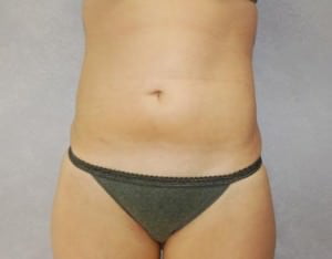 Liposuction Case 2077 After Photo Liposuction