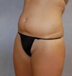 Liposuction