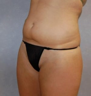 Liposuction Case 2077 Before Photo Liposuction