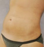 Liposuction