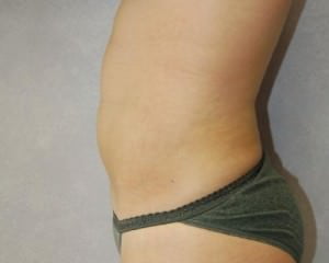 Liposuction Case 2077 After Photo Liposuction