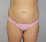Liposuction