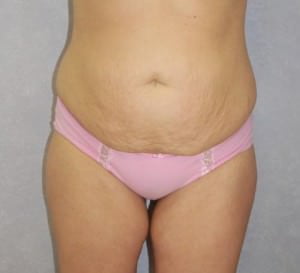 Liposuction