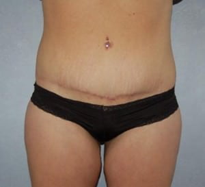 Liposuction
