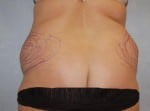 Liposuction