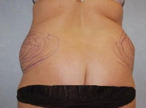 Liposuction