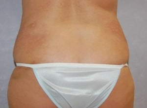 Liposuction