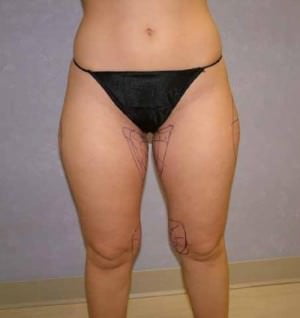 Liposuction