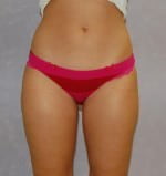 Liposuction