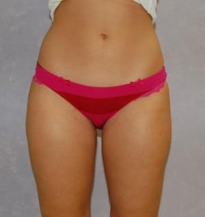 Liposuction