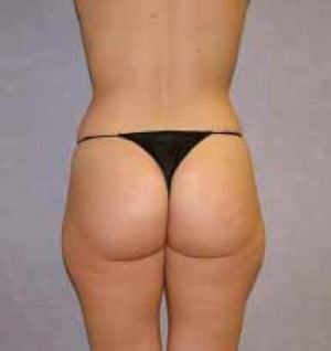 Liposuction