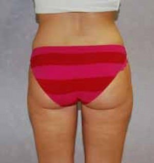 Liposuction