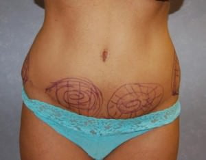 Liposuction