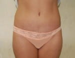 Liposuction