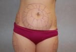 Liposuction