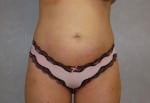 Liposuction