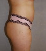 Liposuction