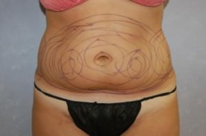 Liposuction