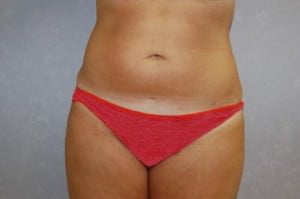 Liposuction