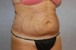 Liposuction