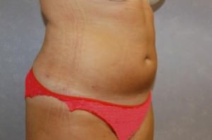 Liposuction