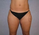 Liposuction