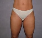 Liposuction