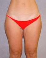 Liposuction