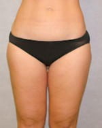 Liposuction