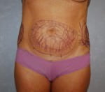 Liposuction