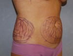 Liposuction